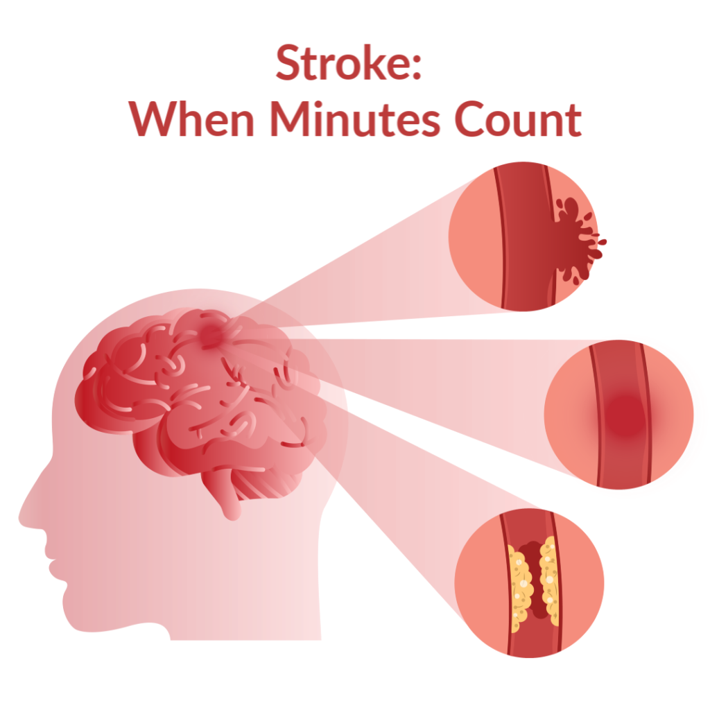 (Nursing) Stroke training module 